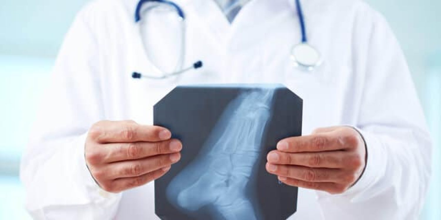rsz_close-up-of-doctor-holding-x-ray-of-human-foot-sbi-300908396-scaled_1